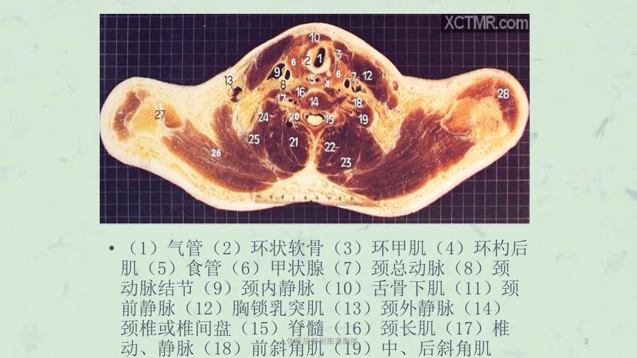 人体断层解剖图谱胸腔课件_第3页