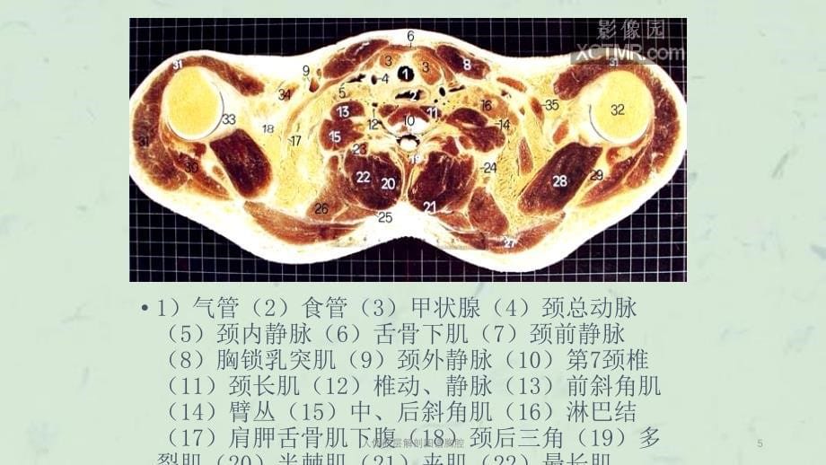 人体断层解剖图谱胸腔课件_第5页