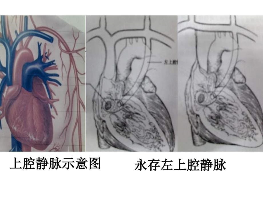 起搏器植入术中少见病例的分析课件_第5页