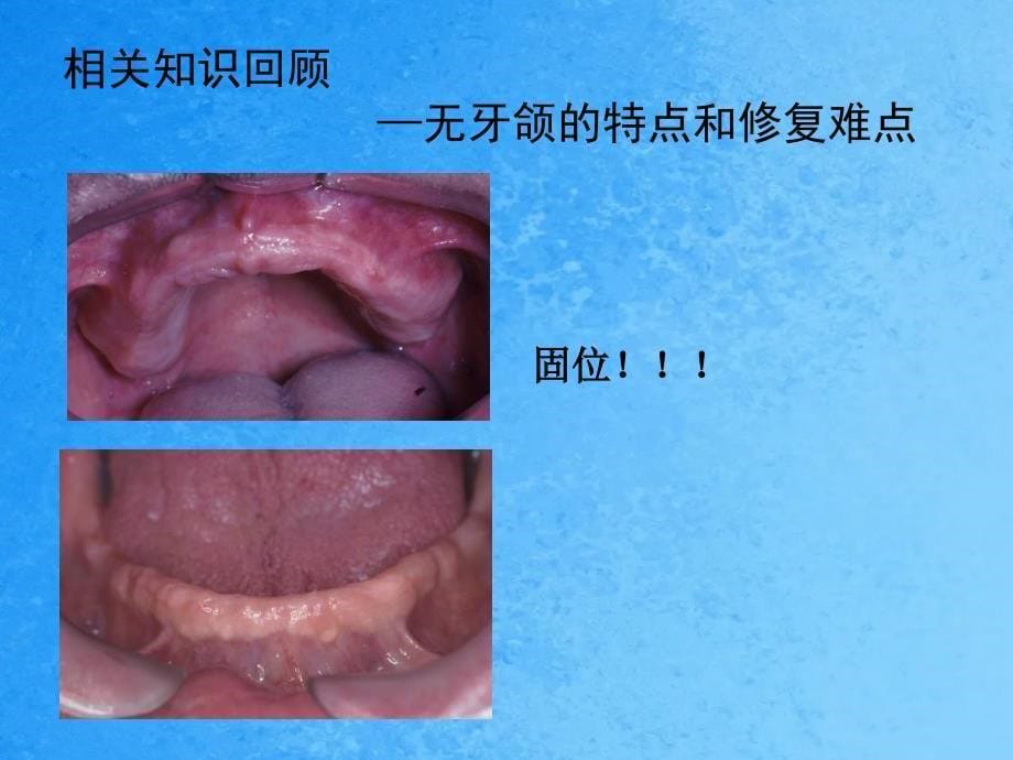 印模与模型制作ppt课件_第5页