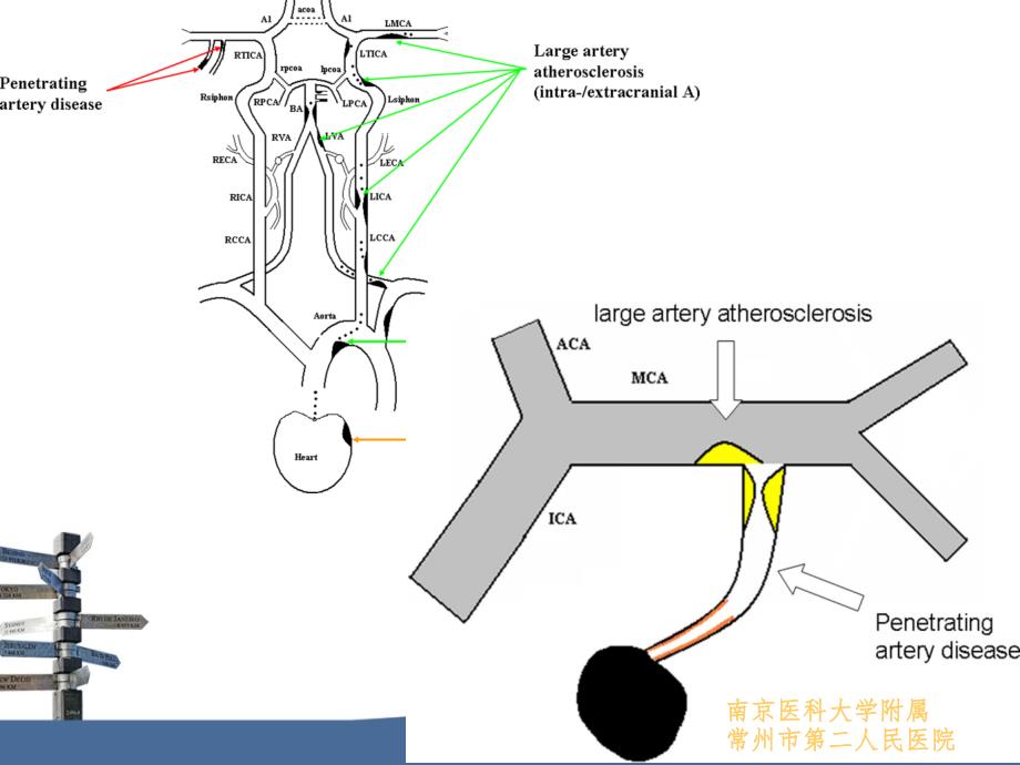 大脑中动脉狭窄的评估与治疗PPT参考幻灯片_第4页