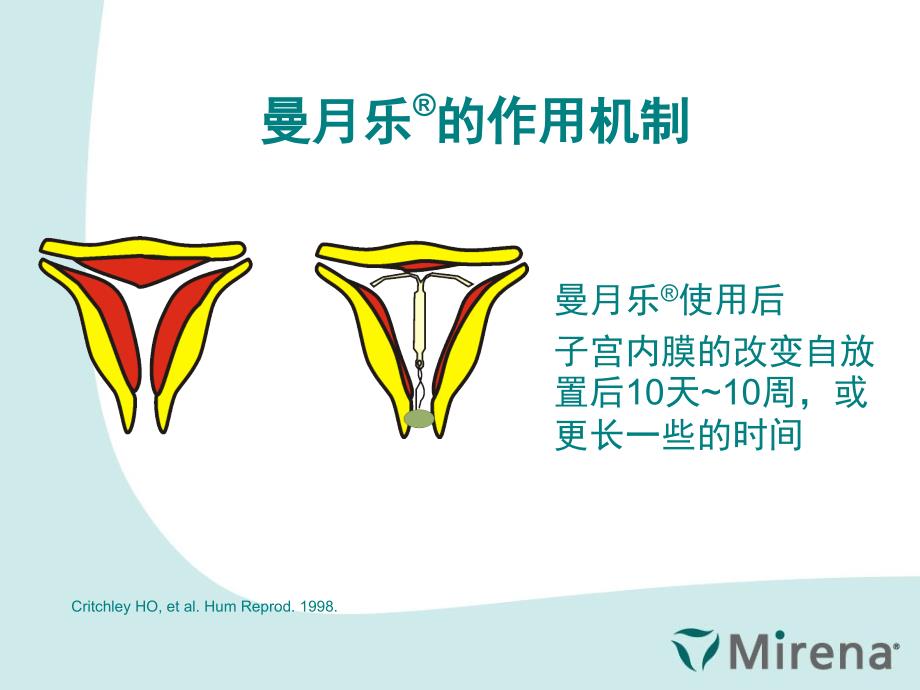 曼月乐治疗子宫内膜异位和腺肌症0827课件_第4页