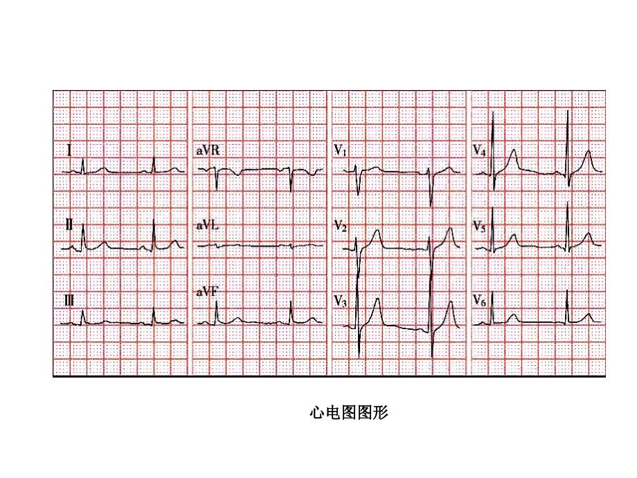 临床心电图 ppt课件_第4页