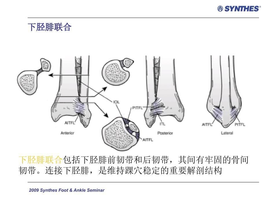 《踝关节骨折分类》PPT课件_第5页