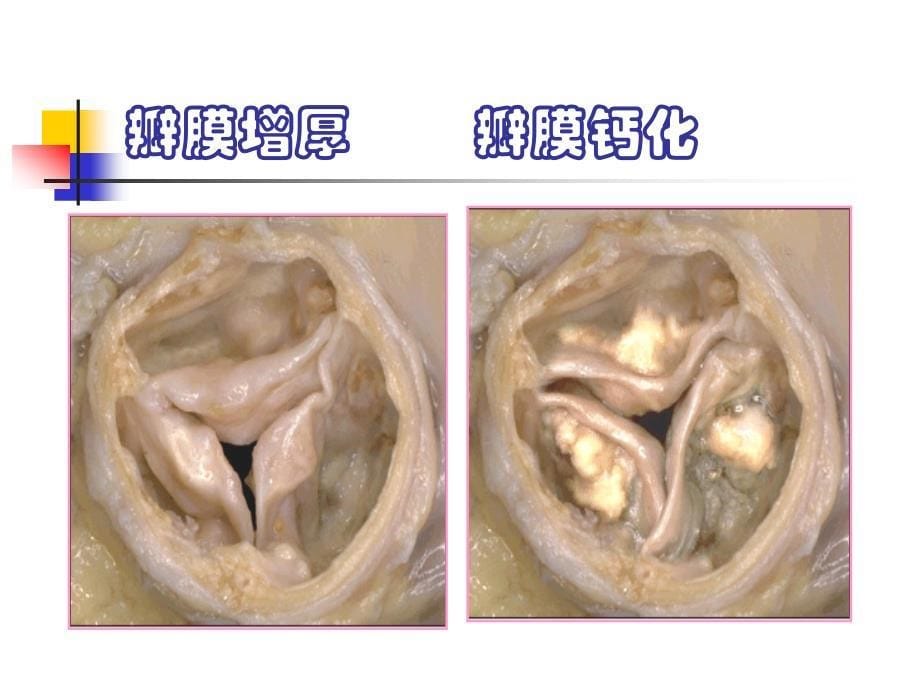 风心病及术前术后护理_第5页