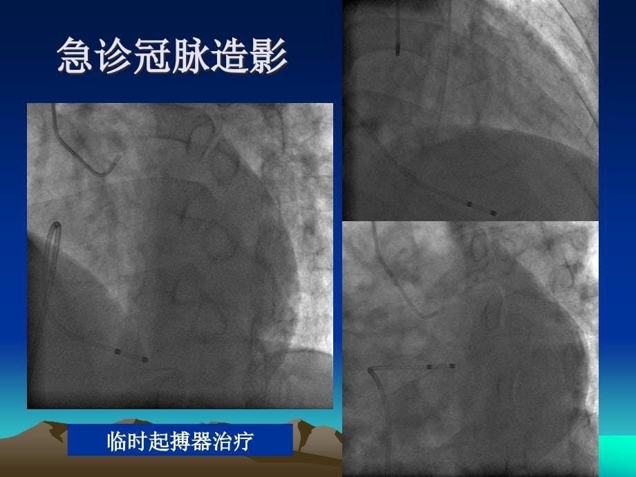 bms应用于急性心肌梗死直接pci杨伟宪_第5页