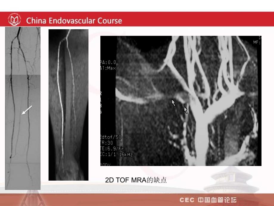 mra在血管疾病诊断中的应用林江_第4页