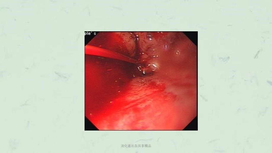 消化道出血共享精品课件_第5页