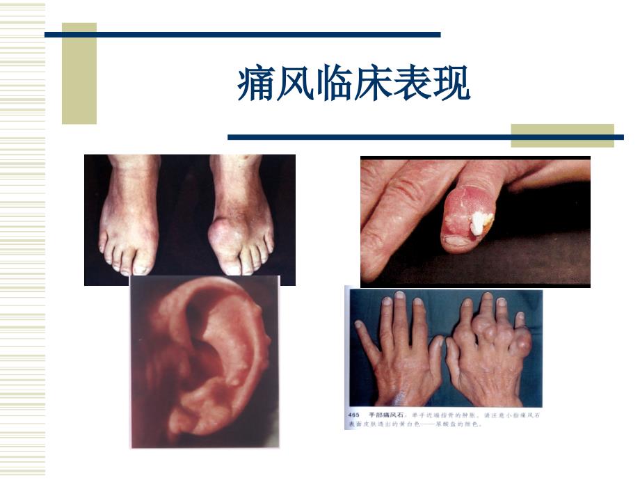 痛风病人的护理课件.ppt_第4页