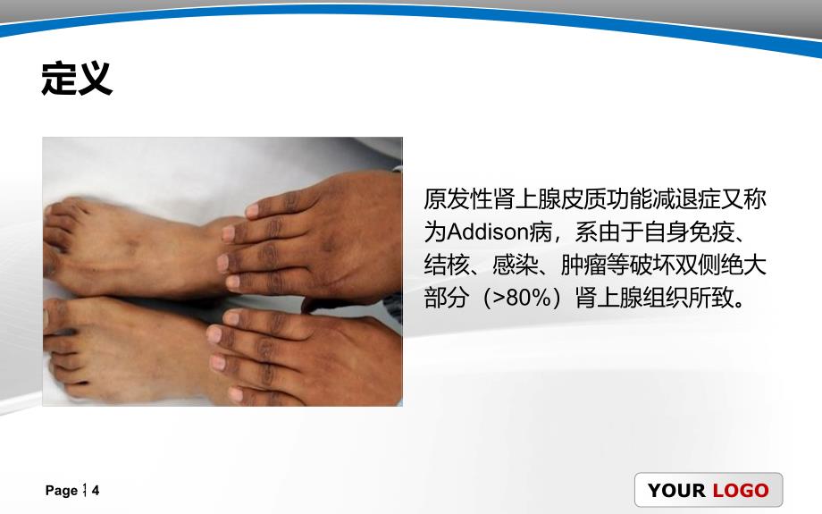 原发性肾上腺皮质功能减退.ppt_第4页