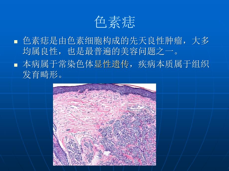 色素痣和恶性黑色素瘤ppt课件.ppt_第4页