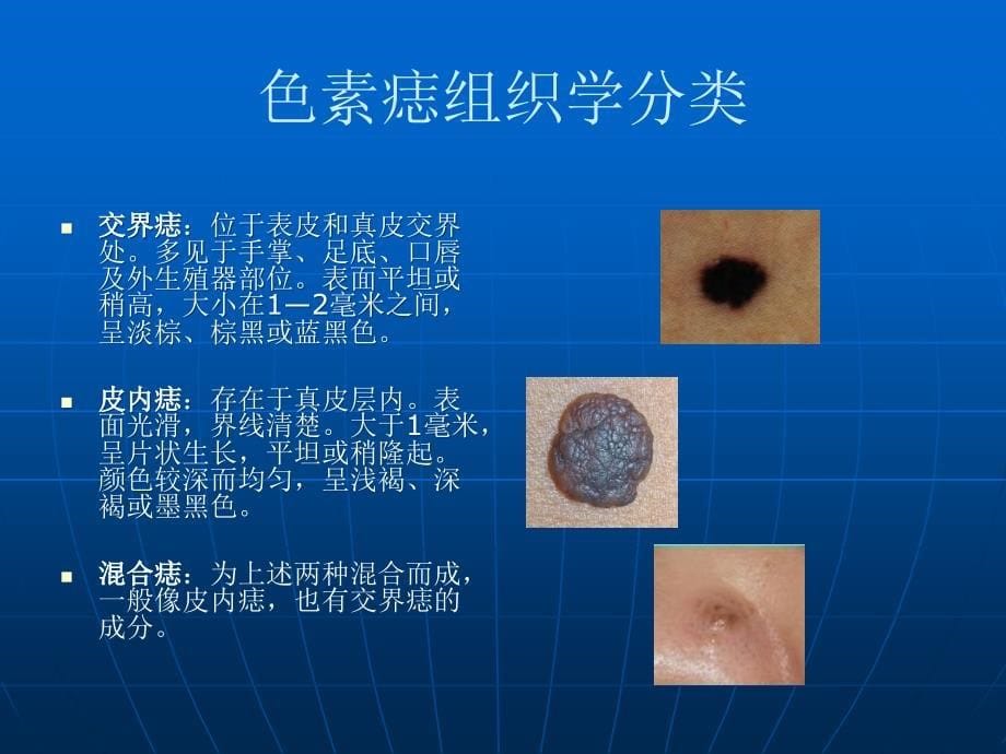 色素痣和恶性黑色素瘤ppt课件.ppt_第5页