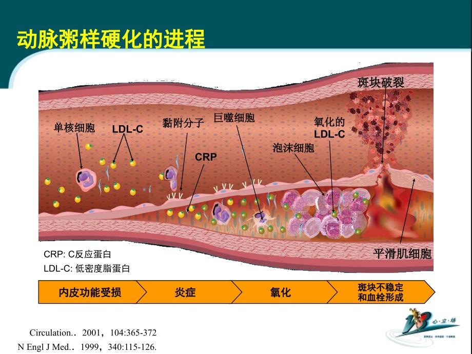 稳定性冠心病仍然需要积极降胆固醇治疗_第4页