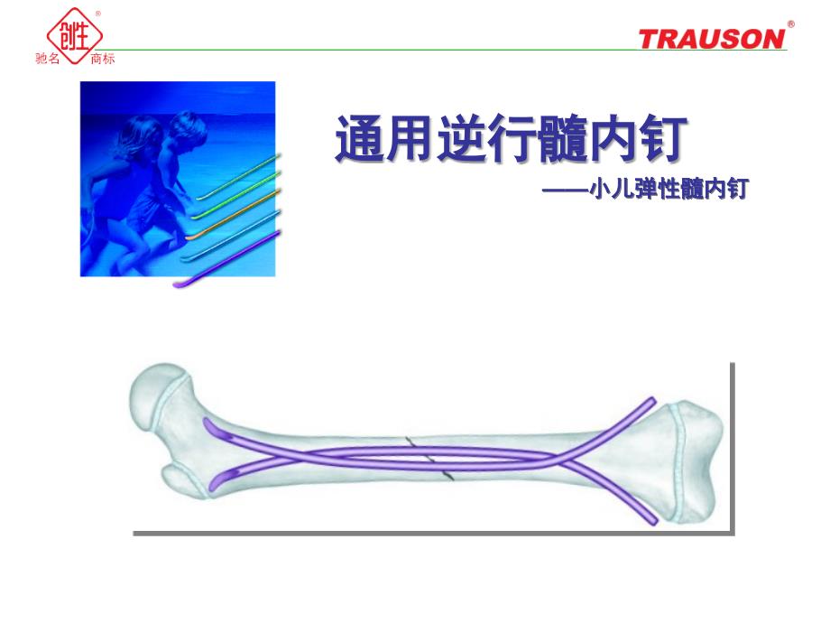 逆行髓内钉—小儿弹性髓内钉课件.ppt_第1页