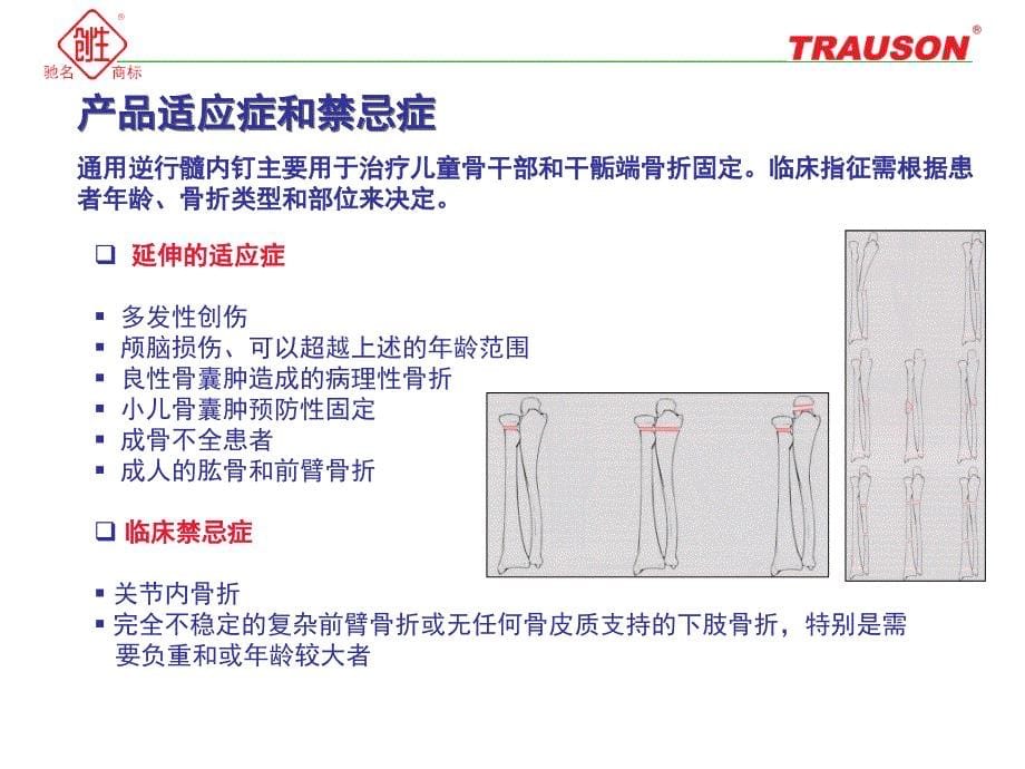 逆行髓内钉—小儿弹性髓内钉课件.ppt_第5页