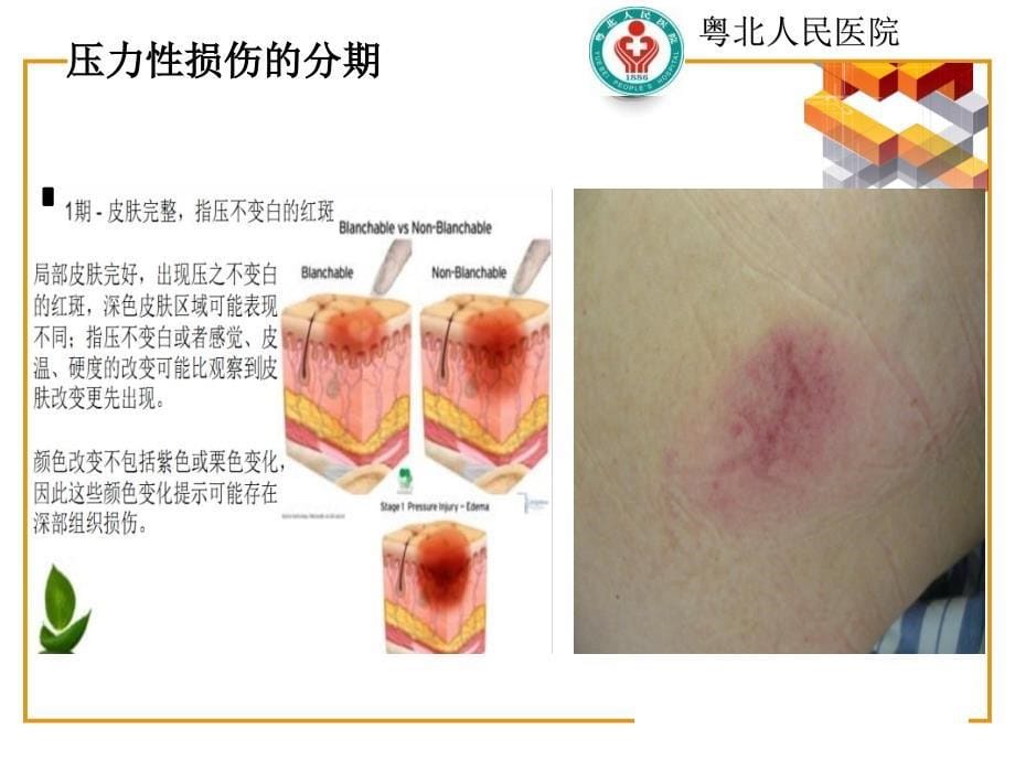 压力性损伤新解读_第5页