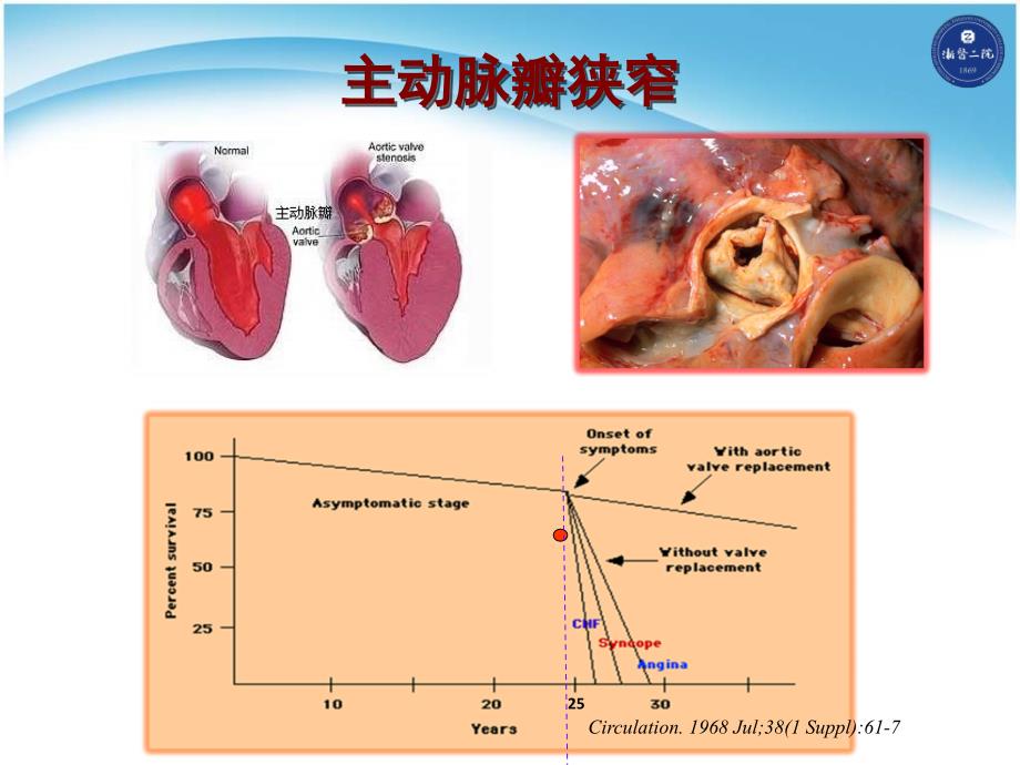 经导管主动脉瓣置入术tavi发展历史现状及循证学依据_第4页