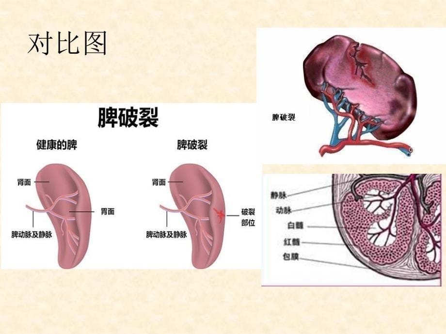 脾破裂护理查房自制.ppt_第5页