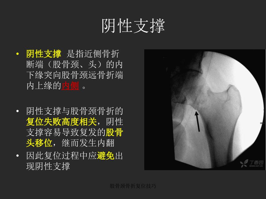 股骨颈骨折复位技巧_第2页