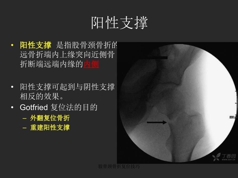 股骨颈骨折复位技巧_第3页