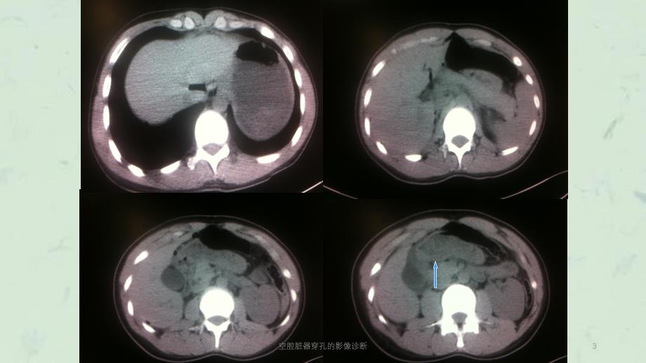 空腔脏器穿孔的影像诊断课件_第3页