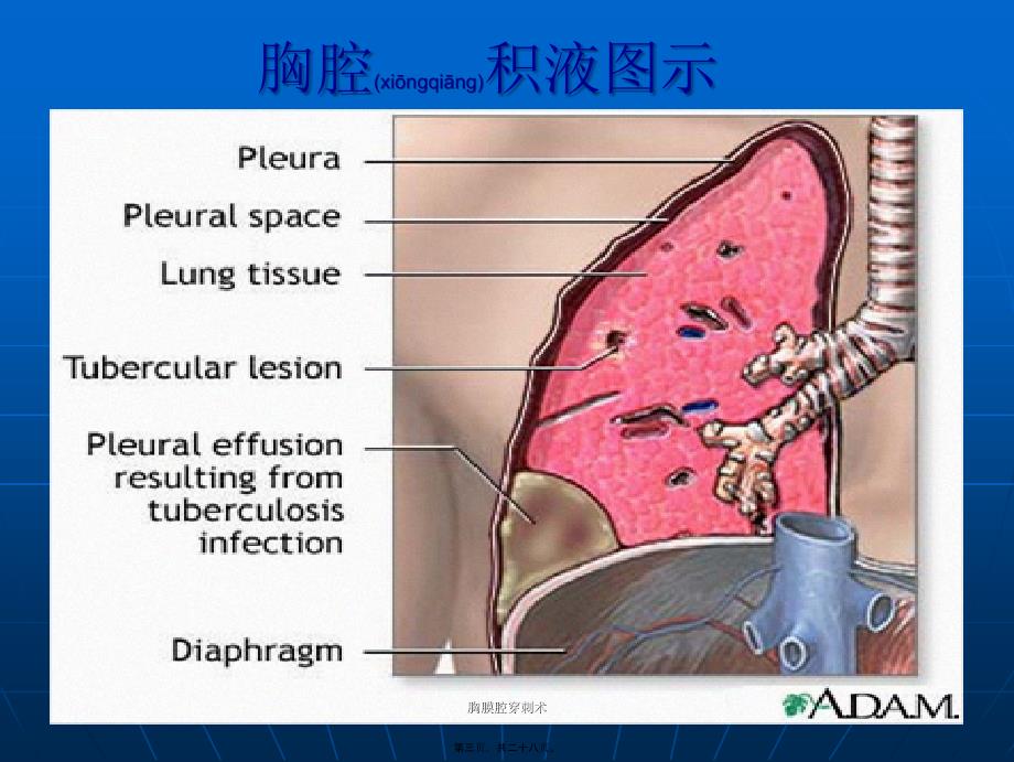 胸膜腔穿刺术课件_第3页