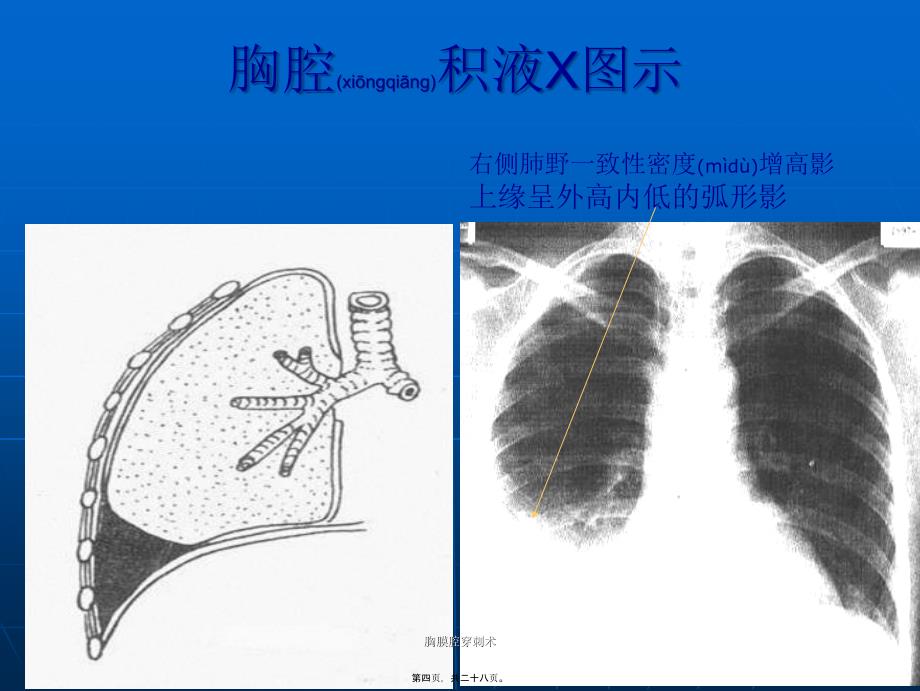 胸膜腔穿刺术课件_第4页