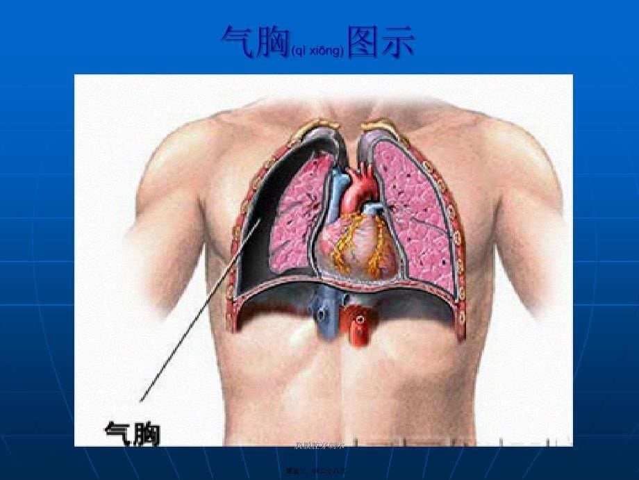 胸膜腔穿刺术课件_第5页