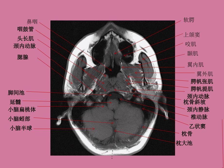 鼻咽部详细mri断层图谱ppt课件_第2页