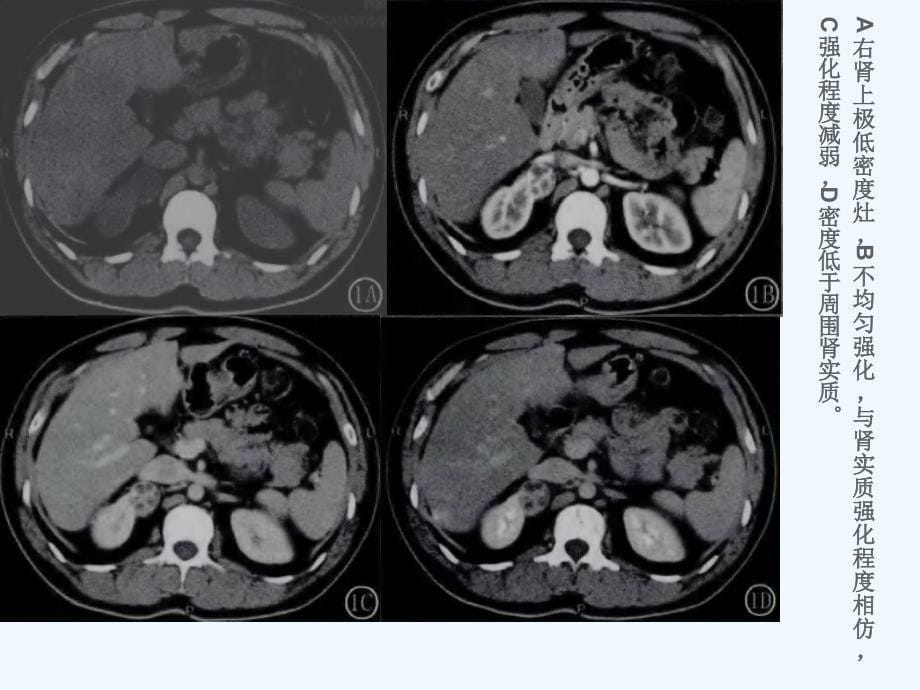 肾癌CT表现课件_第5页