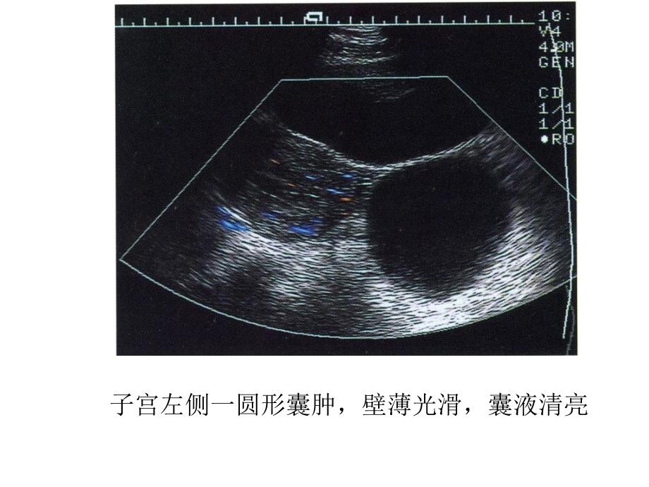 卵巢疾病超声显像鉴别诊断_第4页