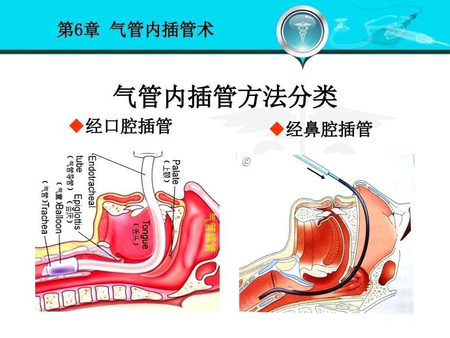 外科学课件：第6章 气管内插管术_第5页