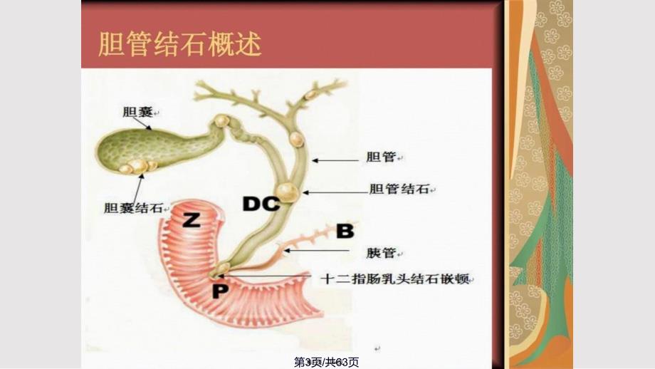 ERCP治疗胆总管结石的护理实用教案_第3页