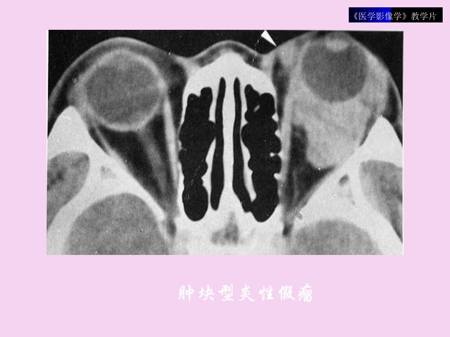 影像学五官头颈部ppt课件_第4页