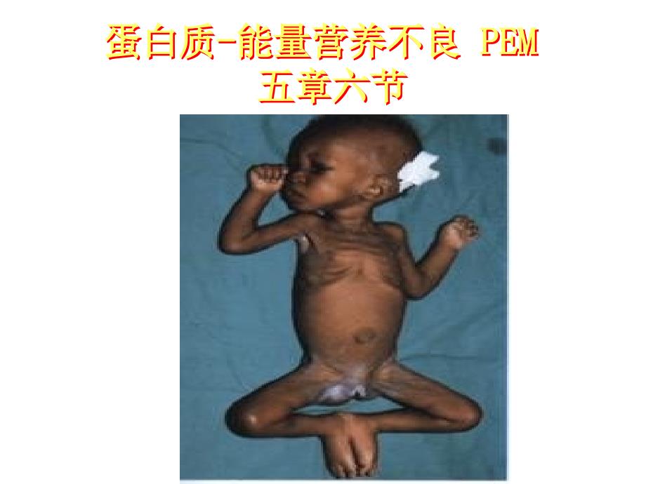 蛋白质能量营养不良症_第1页
