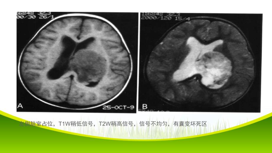 侧脑室占位影像诊断与鉴别_第3页