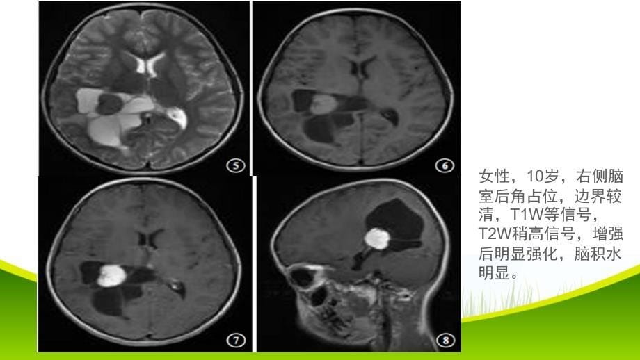 侧脑室占位影像诊断与鉴别_第5页