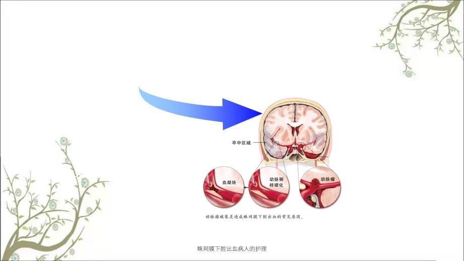 蛛网膜下腔出血病人的护理_第5页