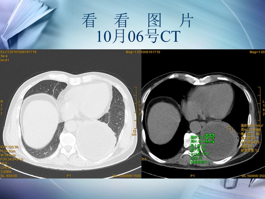 肺脓肿病例讨论(模板).ppt_第4页