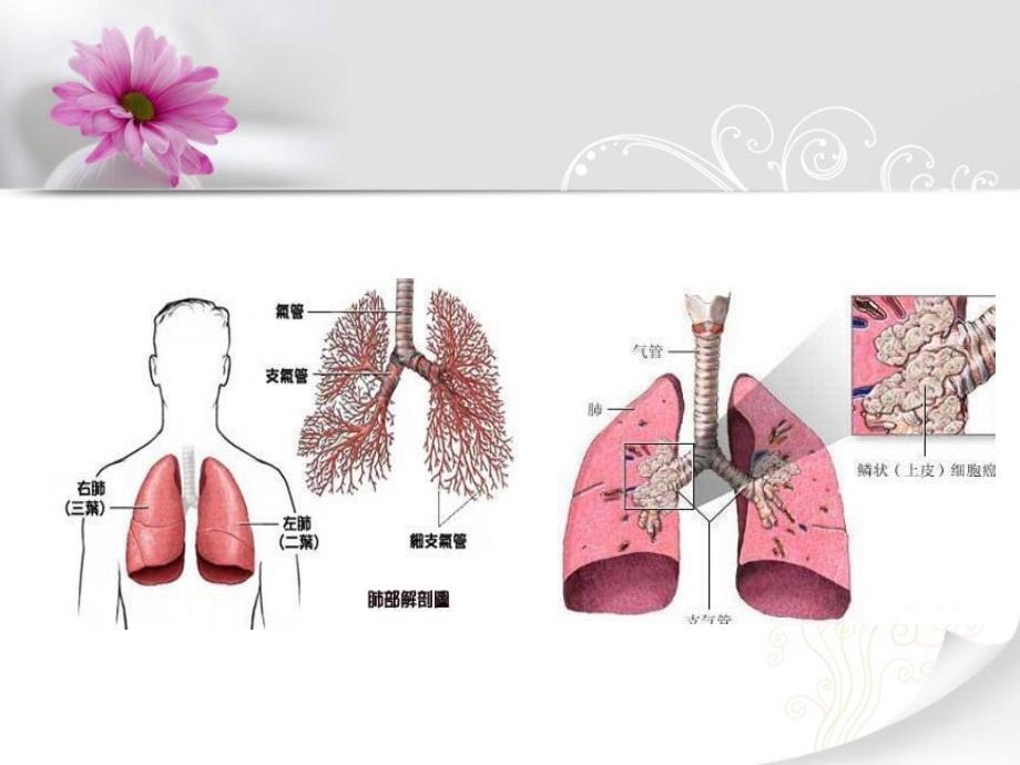 《肺癌个案护理查房》PPT课件_第3页