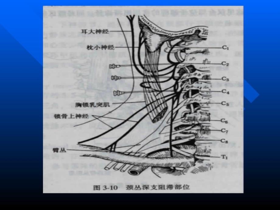 臂丛颈丛神经阻滞麻醉.ppt_第3页