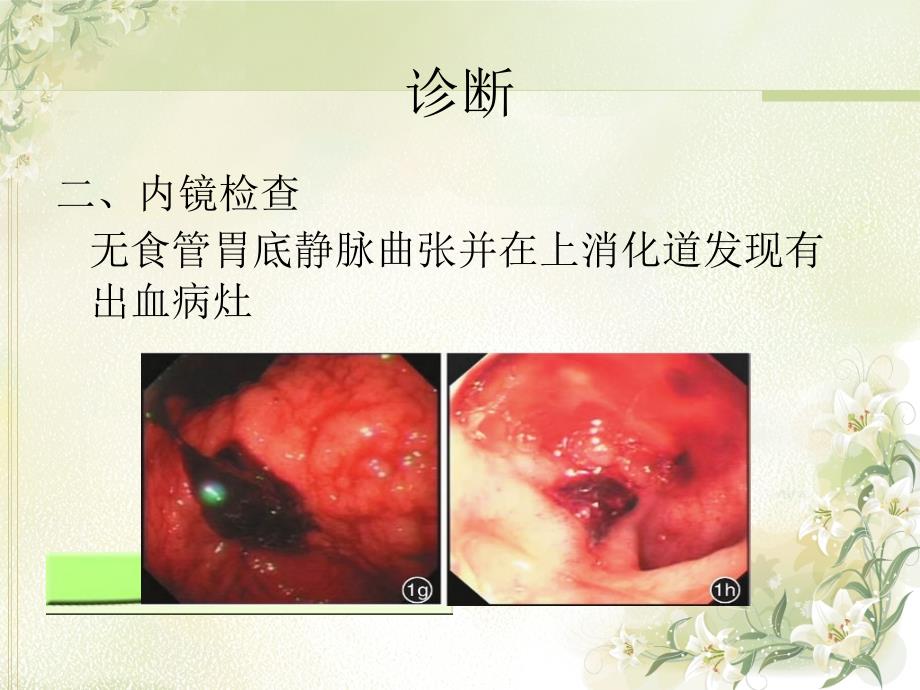 急非静脉性上消化道出血诊治ppt课件_第4页