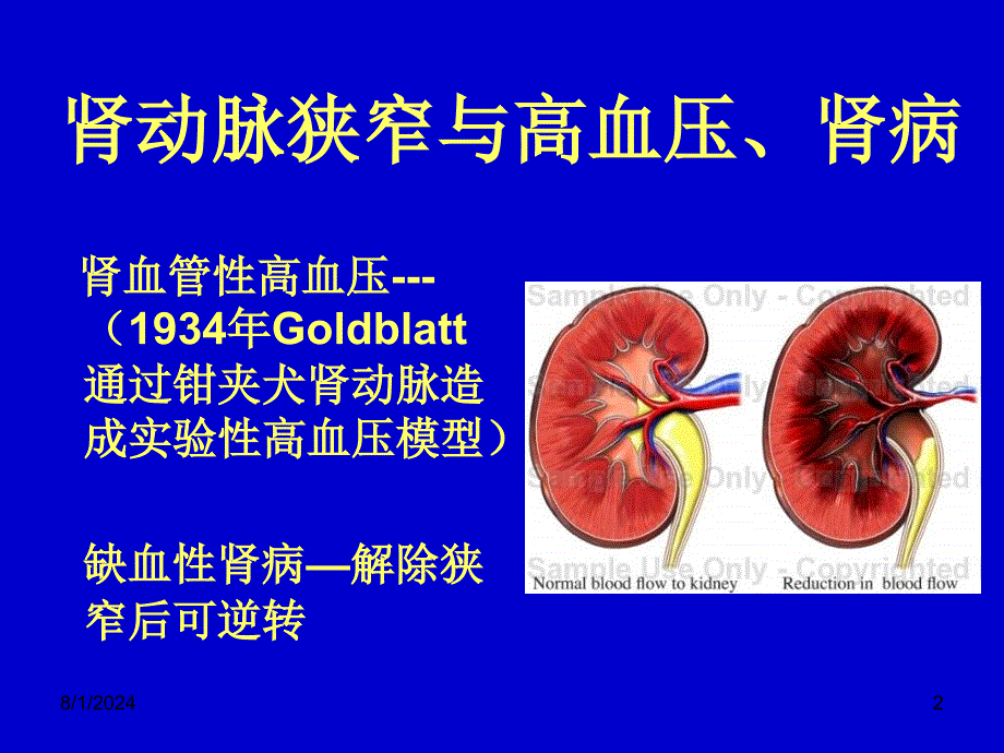 肾血管性高血压的诊断与治疗_第2页