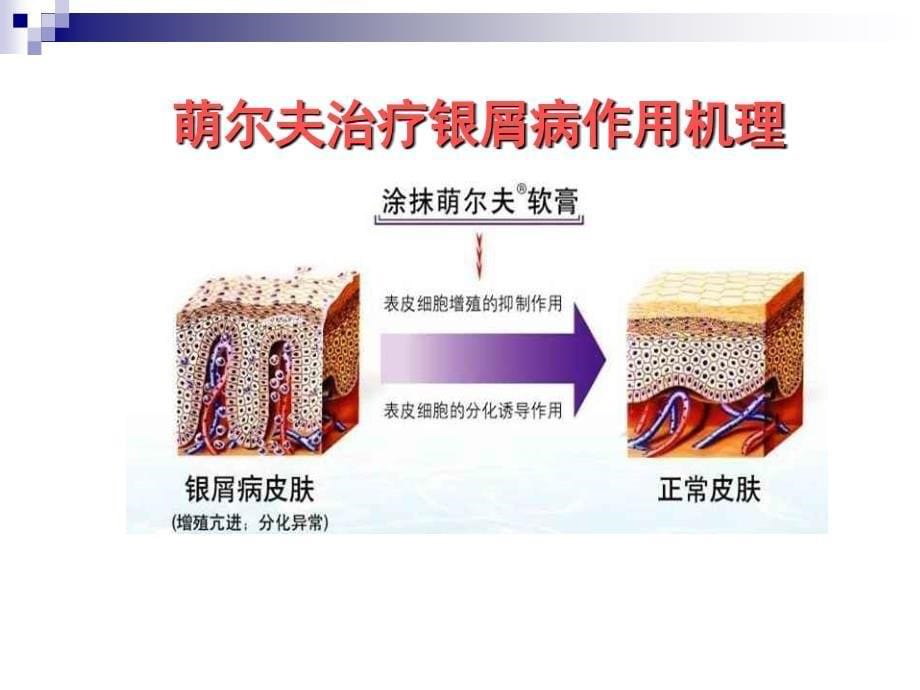 他卡西醇在银屑病治疗中的临床应用(惠州)_第5页