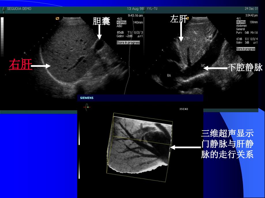 腹部常见病的超声诊断课件.ppt_第4页