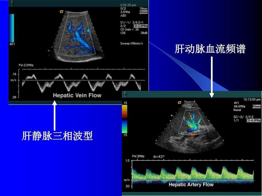 腹部常见病的超声诊断课件.ppt_第5页