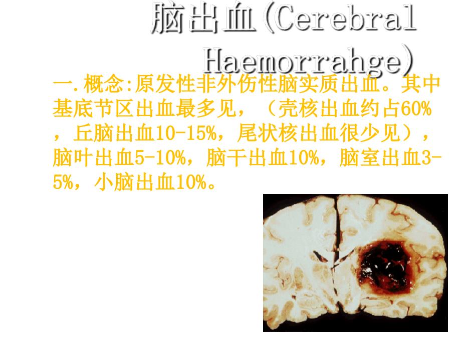 分水岭脑梗死PPT课件_第2页