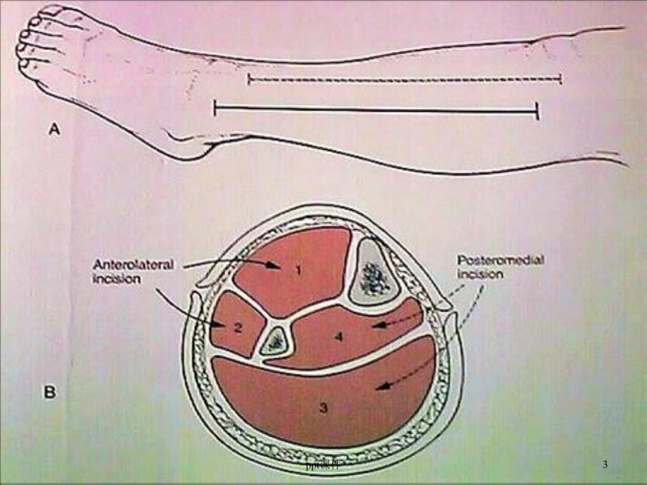 骨筋膜室综合征的观察与护理课件_第3页