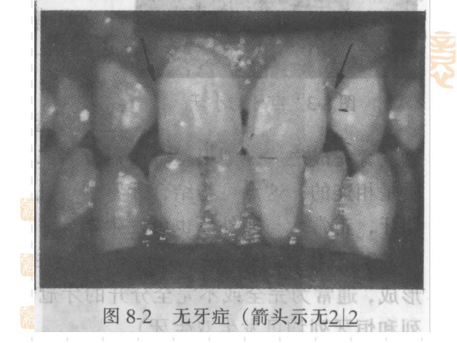 《牙发育异常》课件_第5页