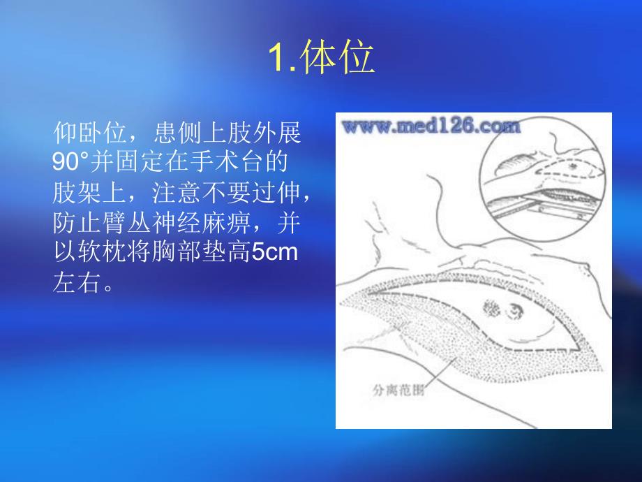 乳腺癌根治术步骤课件.ppt_第2页